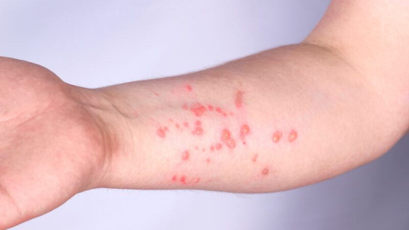 Explosão da Mpox: São Paulo vira o epicentro do vírus no Brasil